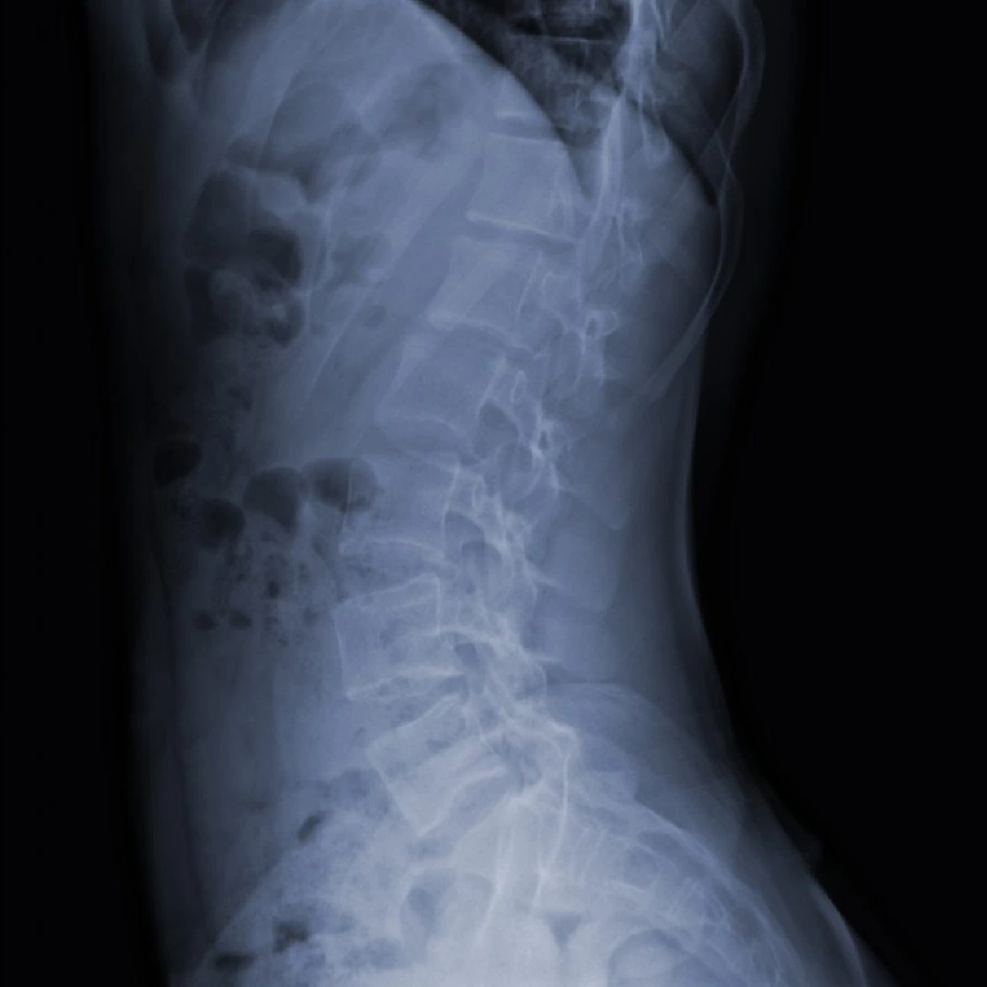 Cirugía de columna cervical