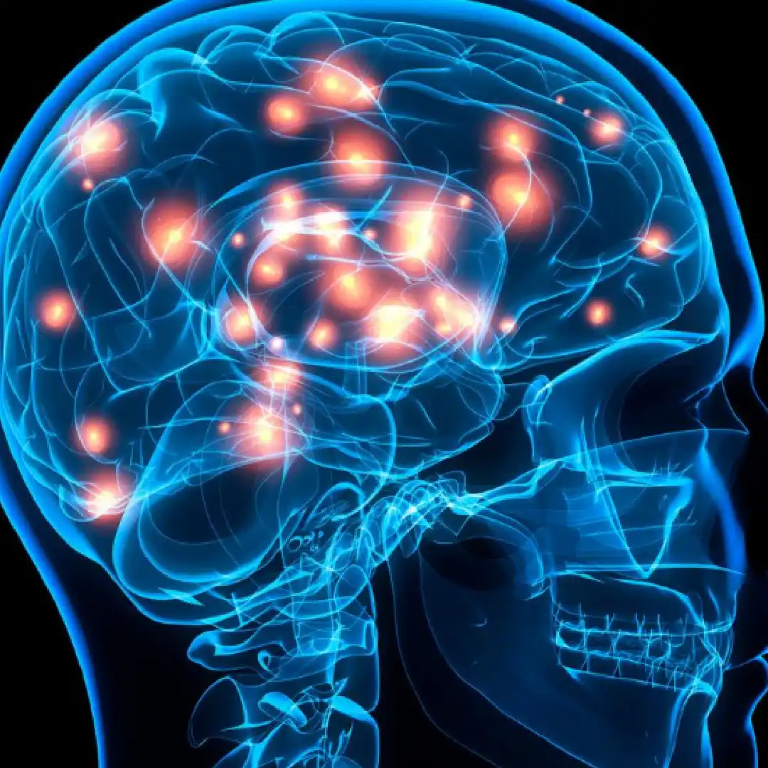 Cirugía de la epilepsia refractaria